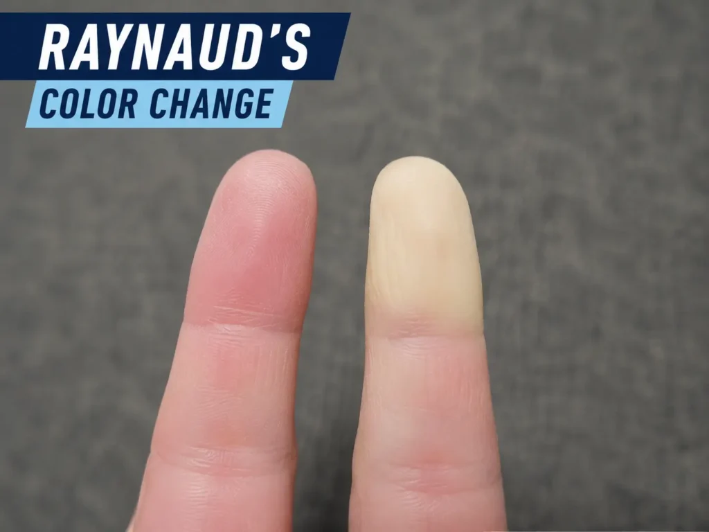 Raynaud's finger color change cold exposure