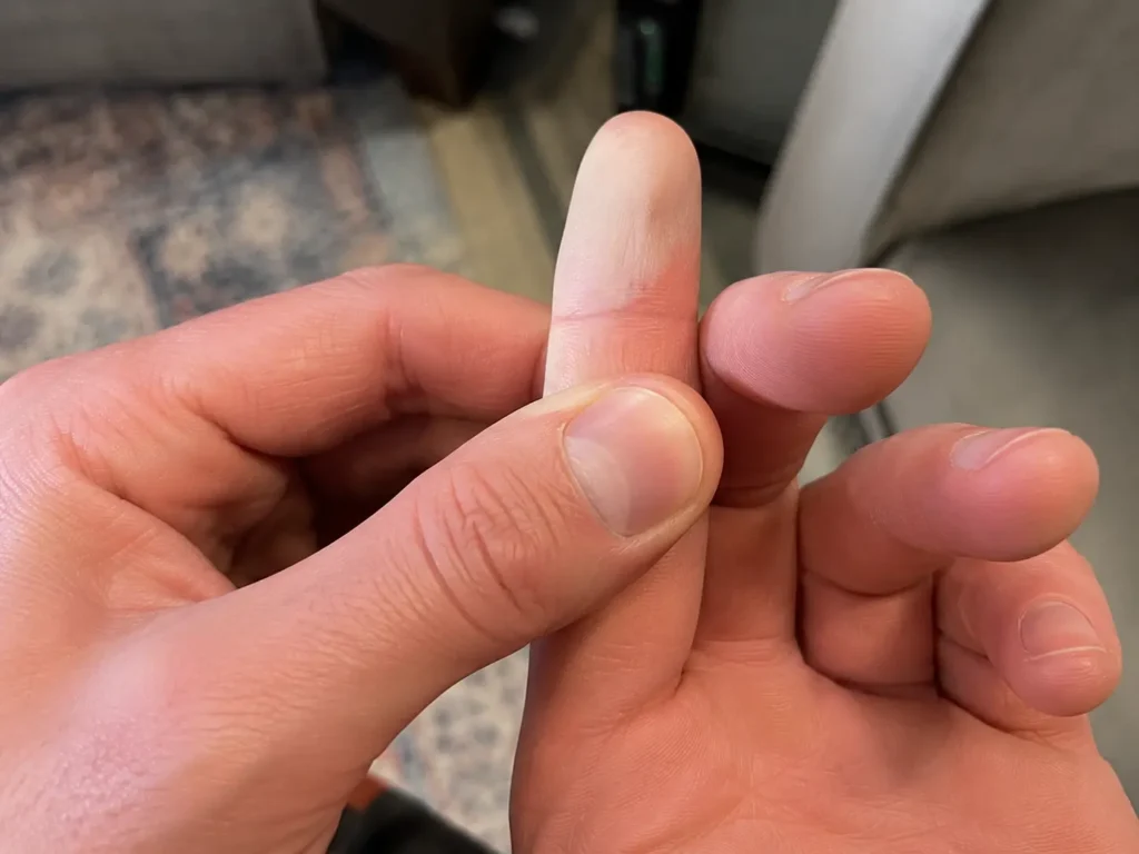 Performing a finger capillary refill test for why do my fingers go numb skiing