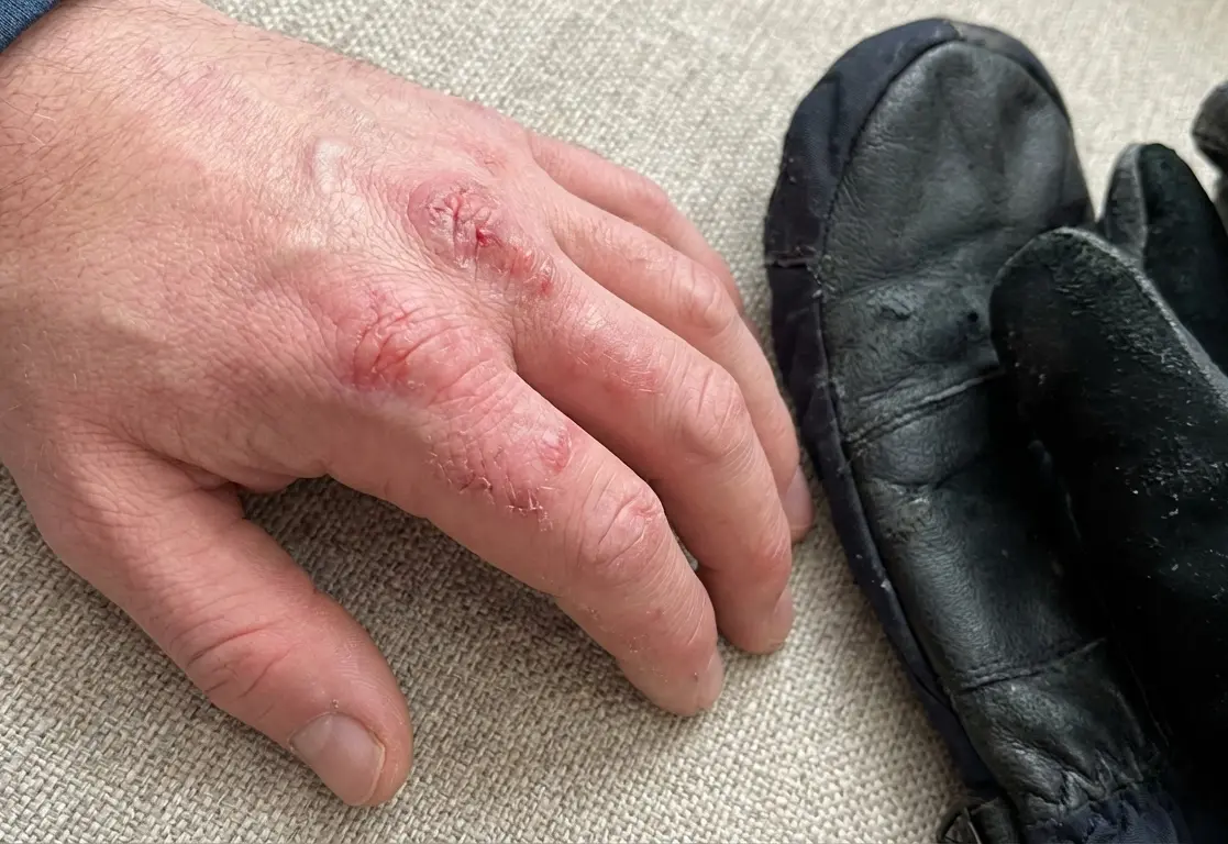 A close-up of red, irritated skin on knuckles to show why do ski glove liners cause skin irritation